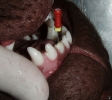 Эндодонтия. Лечение зубных каналов.